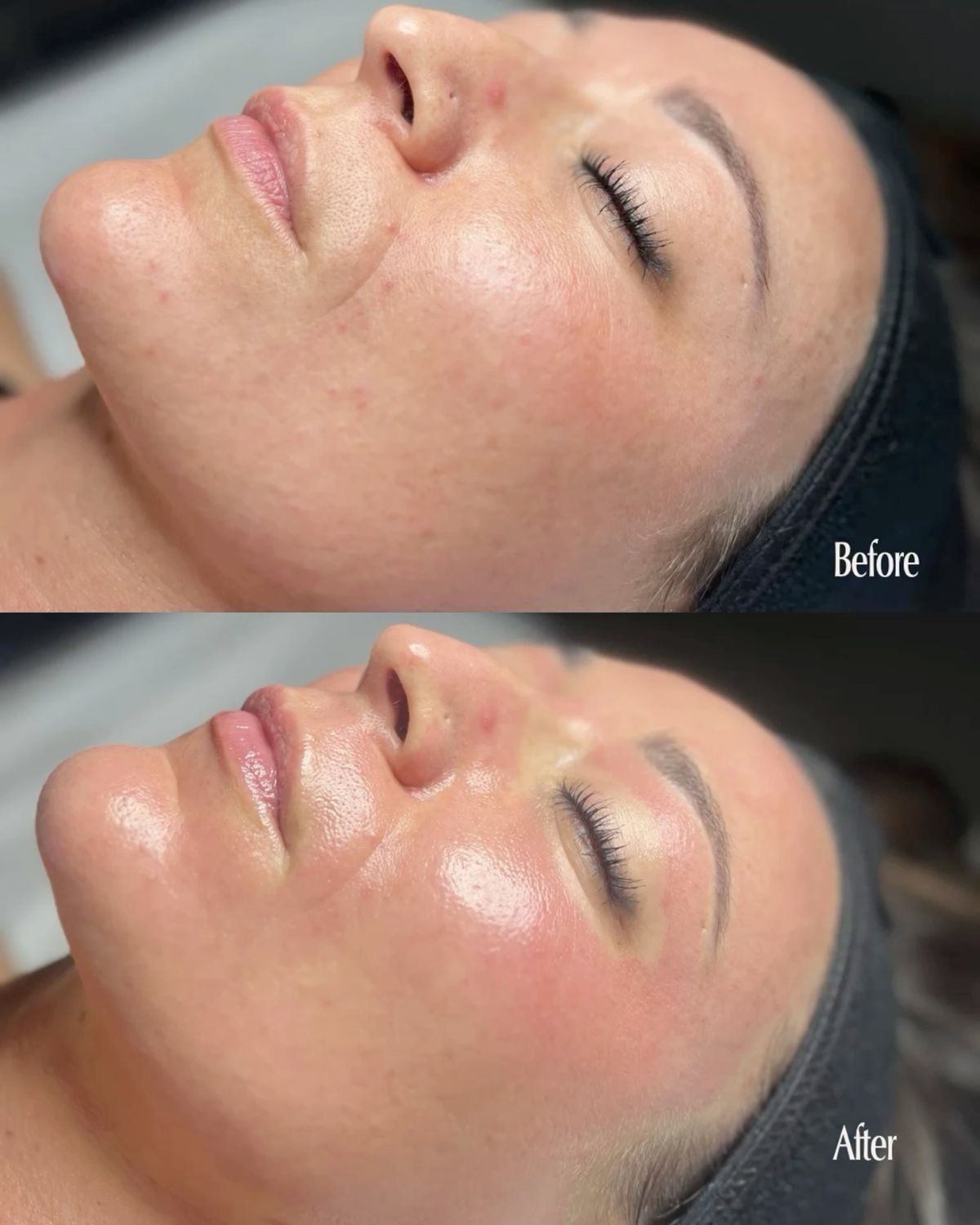 Dermapen facial - Procedură