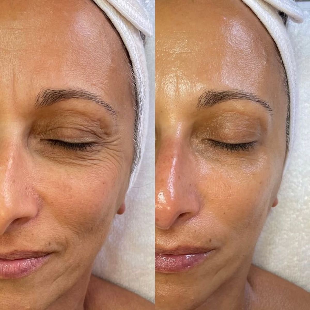 Dermapen facial - Procedură