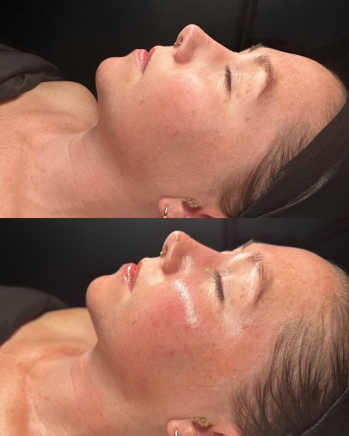 Dermapen facial - Procedură