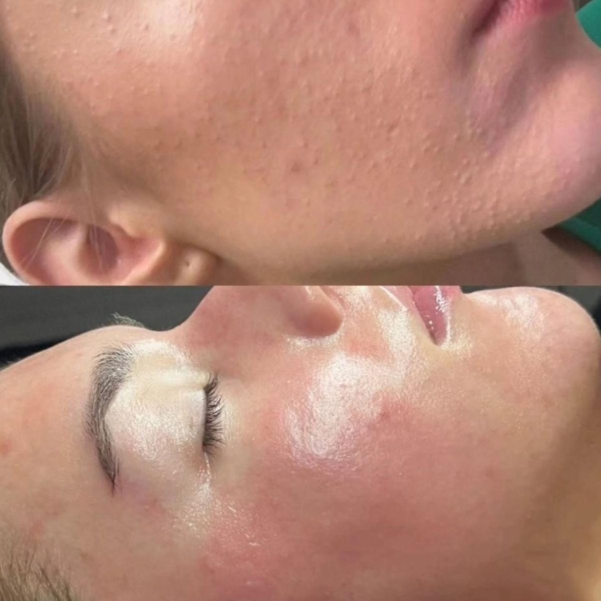 Dermapen facial - Procedură