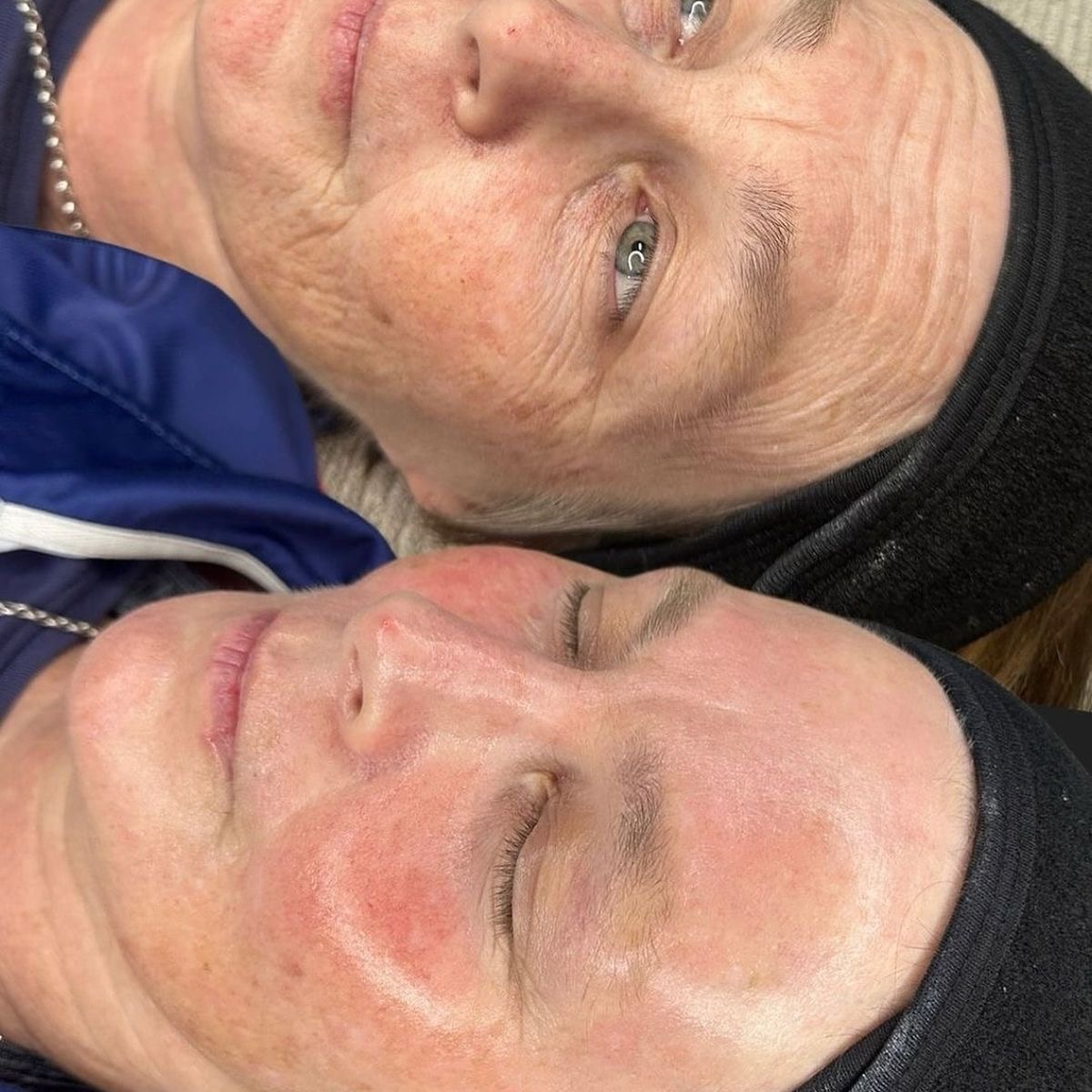 Dermapen facial - Înainte