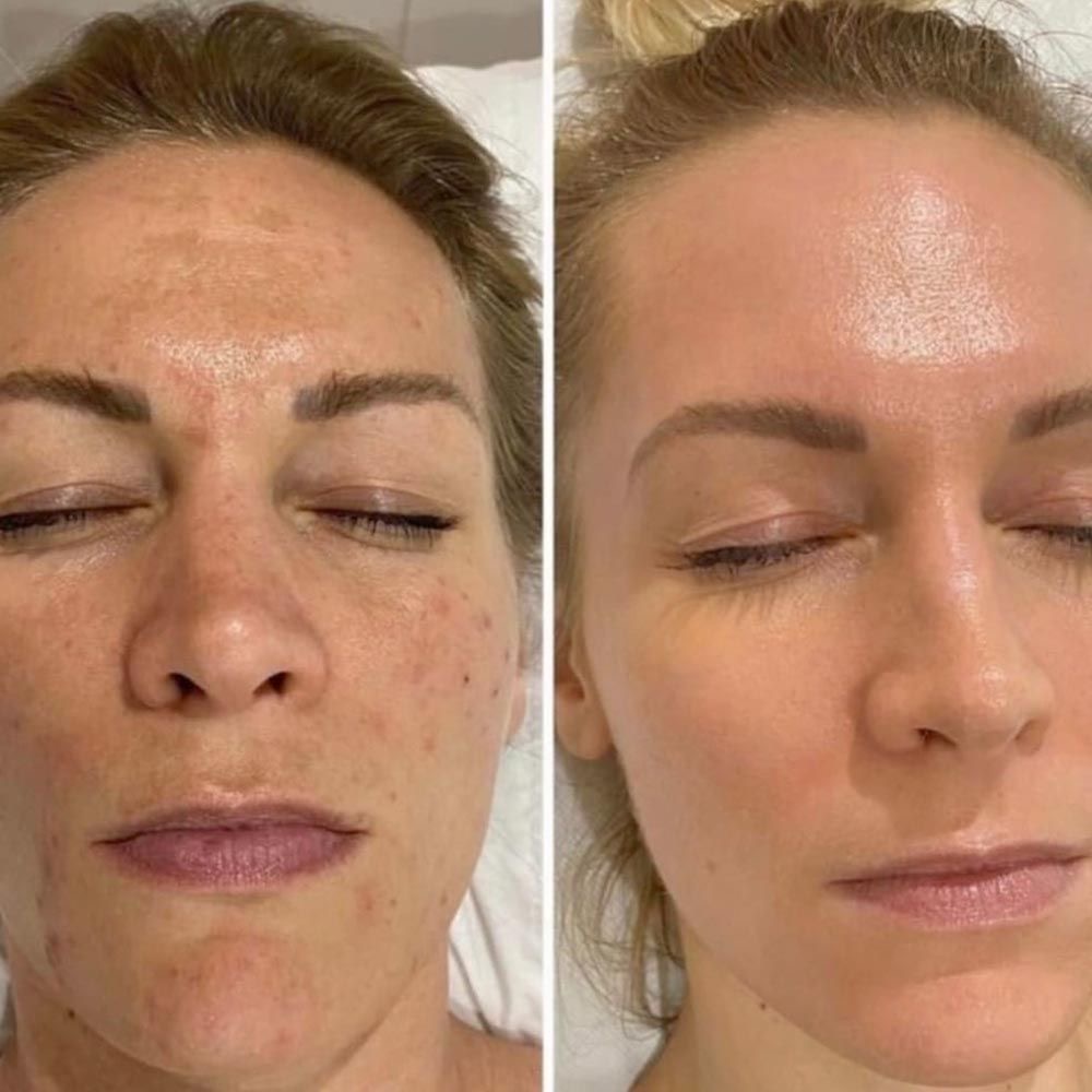 Dermapen facial - După