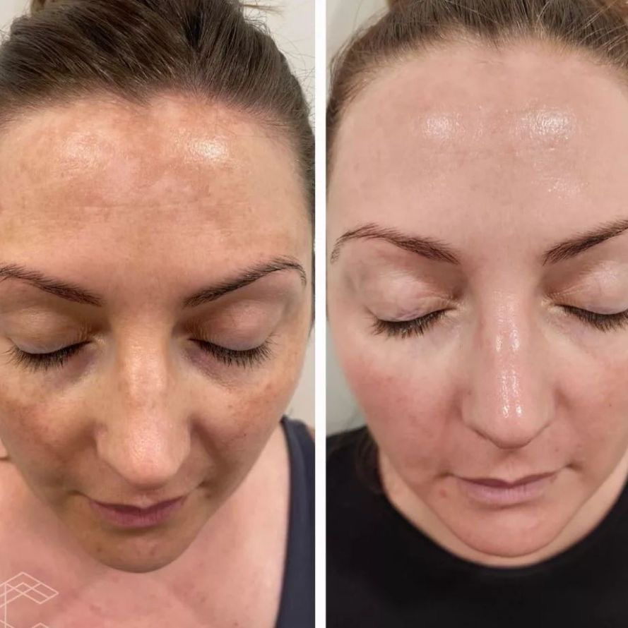 Dermapen facial - Procedură