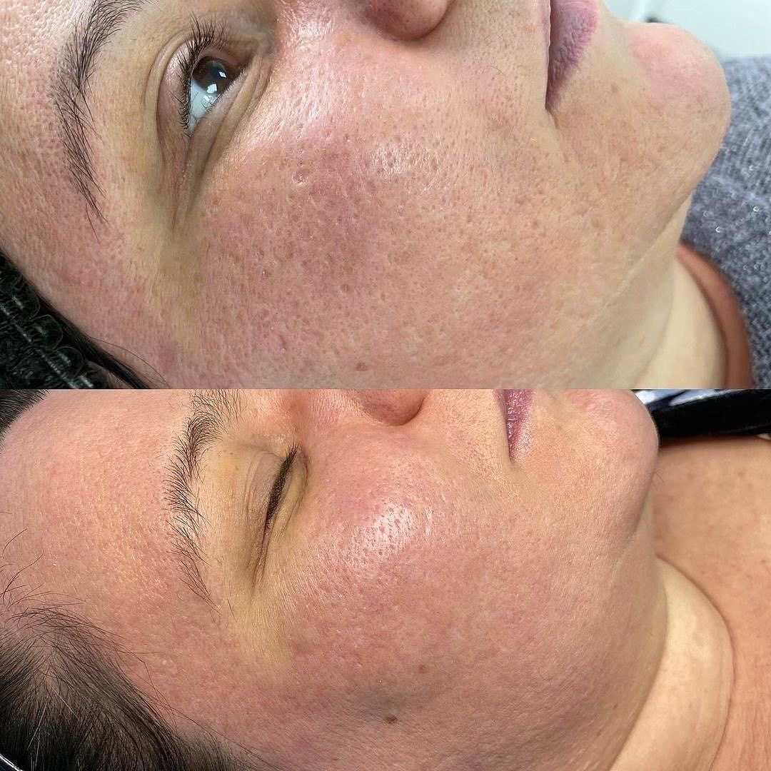 Dermapen facial - Procedură