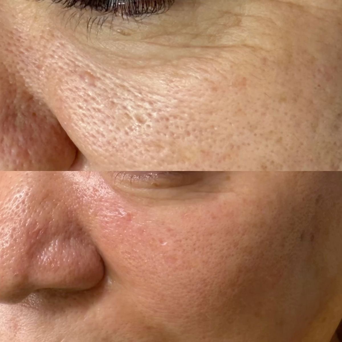 Dermapen facial - Procedură