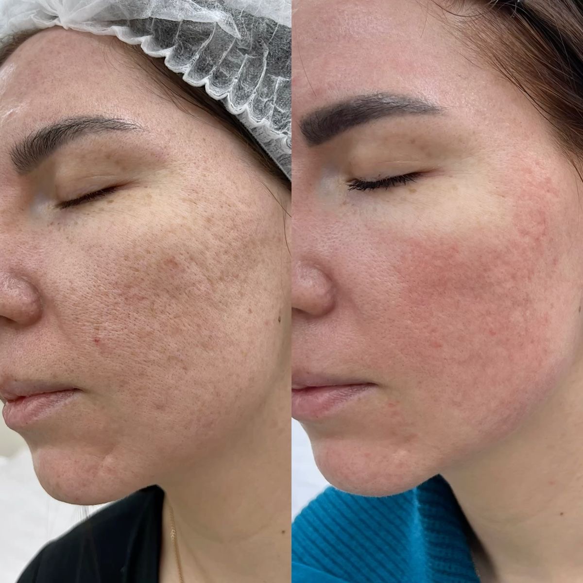 Dermapen facial - Procedură