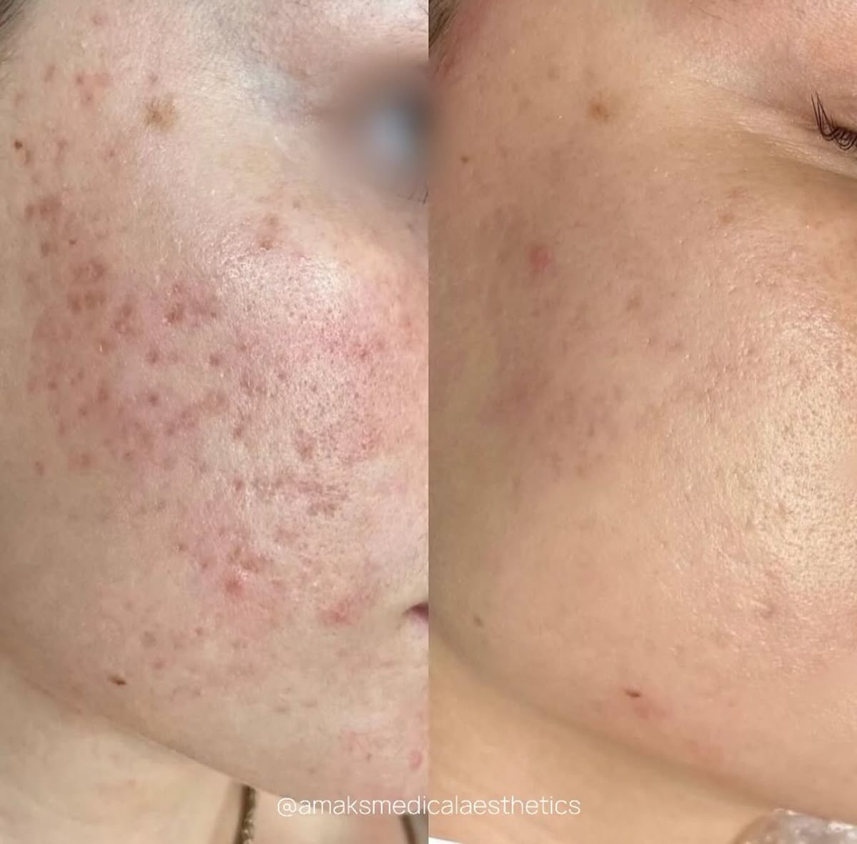 Dermapen facial - Procedură