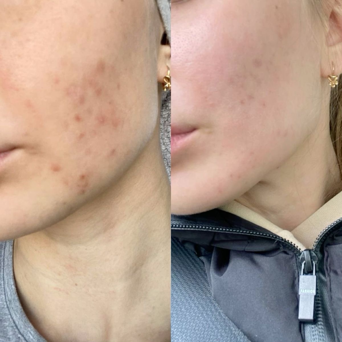 Dermapen facial - Procedură