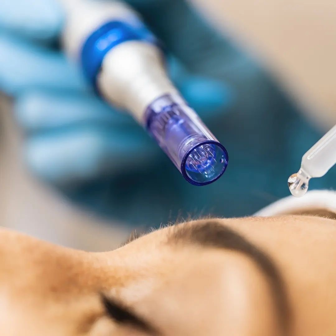 DermaPen Facial