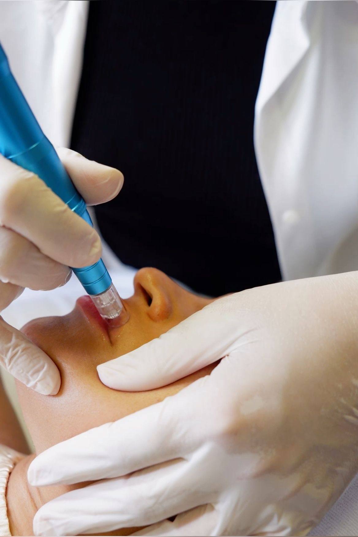 DermaPen Buze