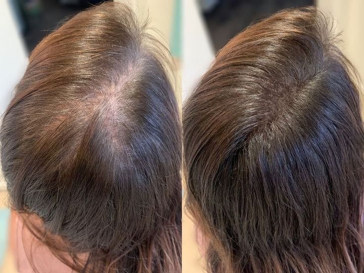 Dermapen scalp - După
