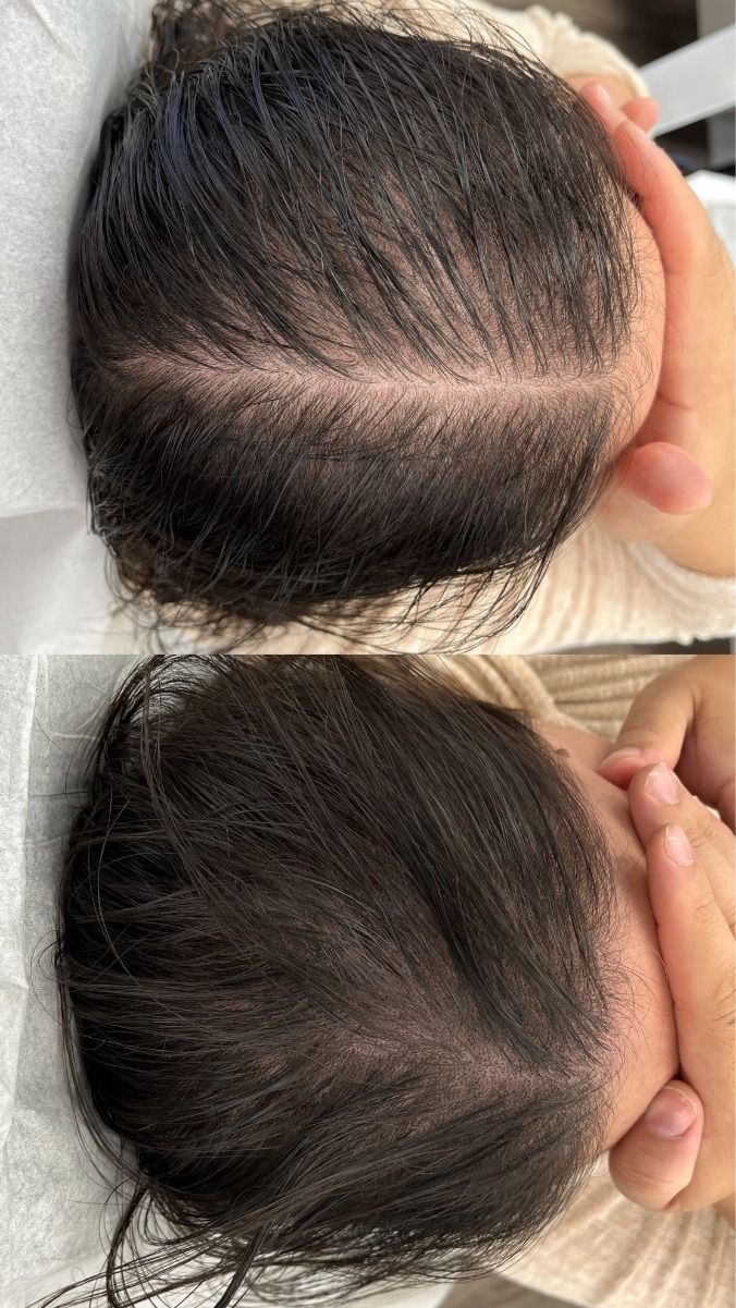 Dermapen scalp - Înainte