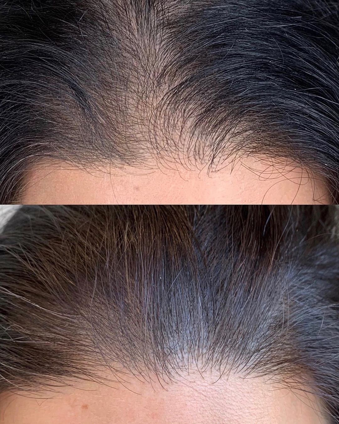 Dermapen scalp - Procedură