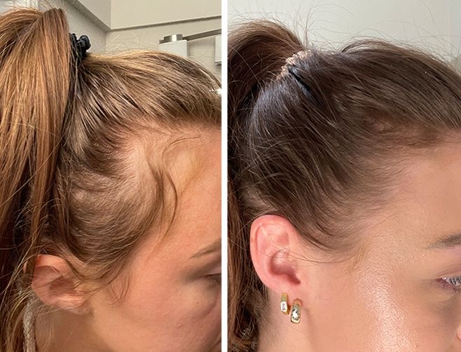 Dermapen scalp - Procedură