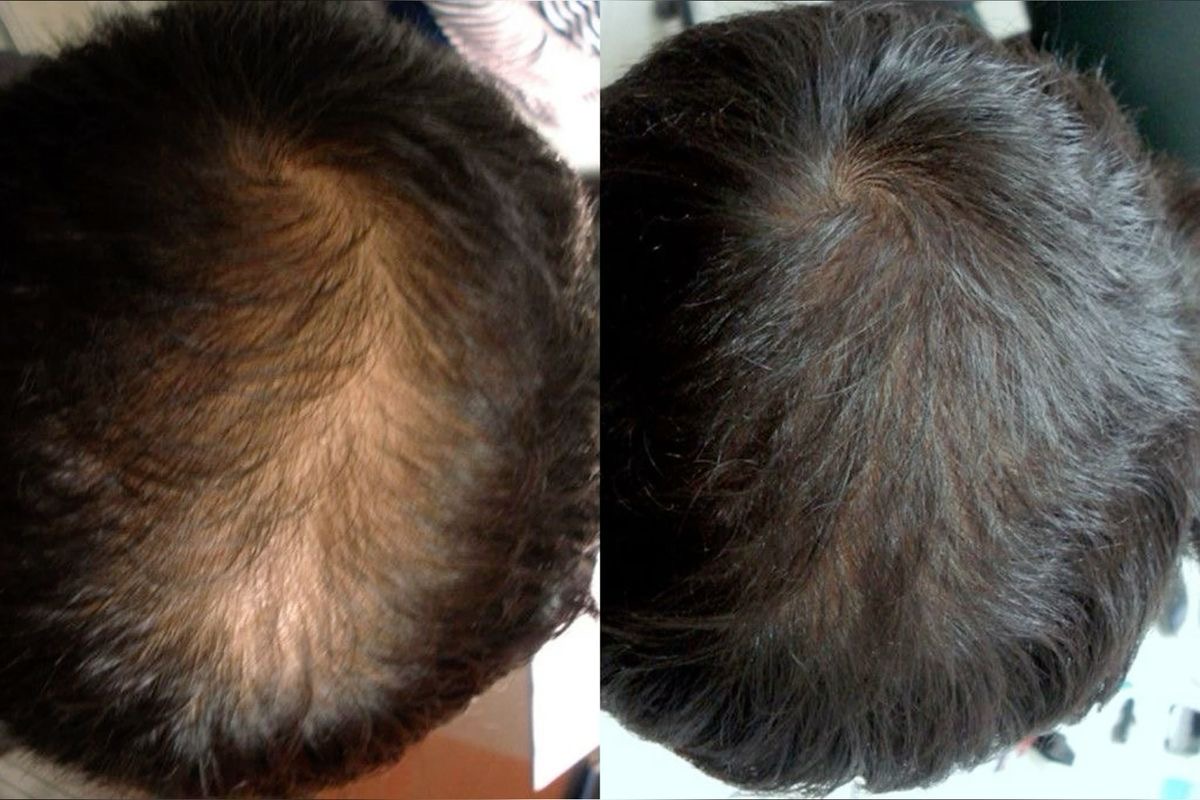 Dermapen scalp - Procedură