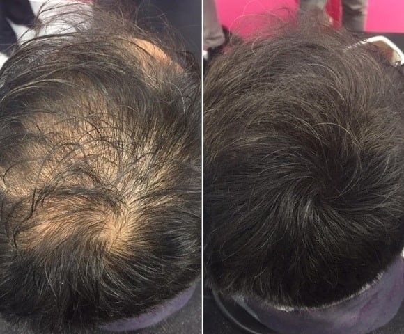 Dermapen scalp - Procedură