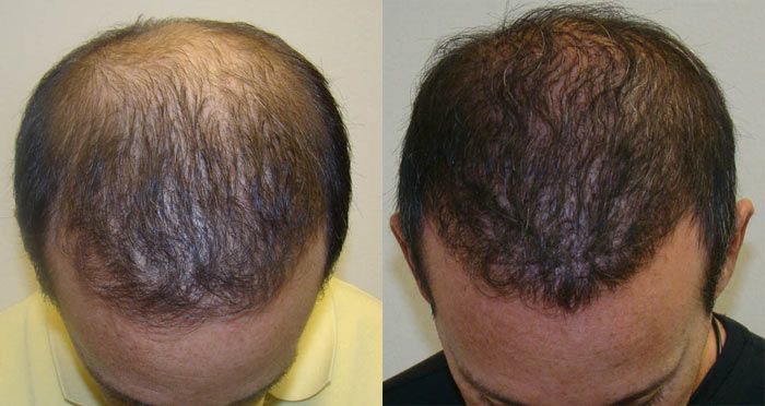 Dermapen scalp - Procedură