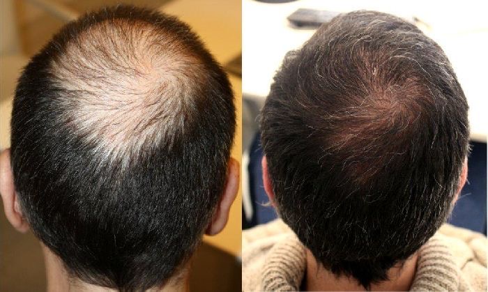 Dermapen scalp - Procedură