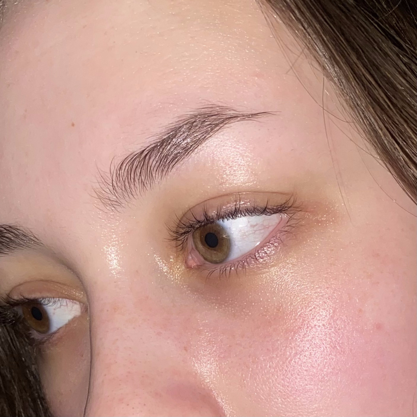 Peri-orbital Before & After