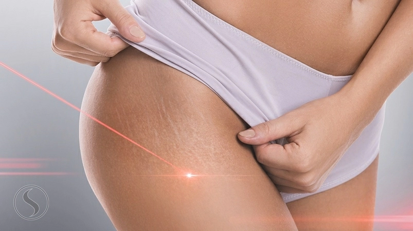 DermaPen Vergeturi Program