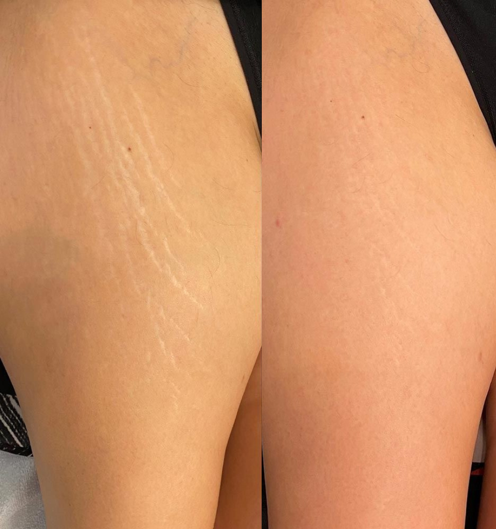 DermaPen Vergeturi