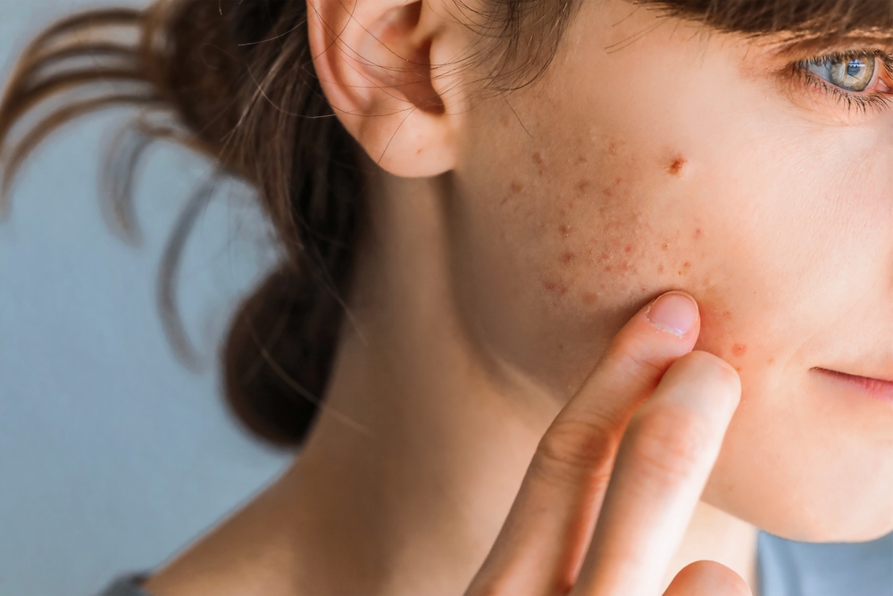 Stop Acne Peeling
